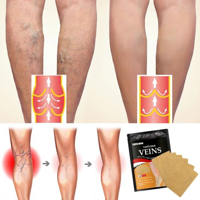 PARCHE PARA VENAS VARICES VARICOSE VEINS