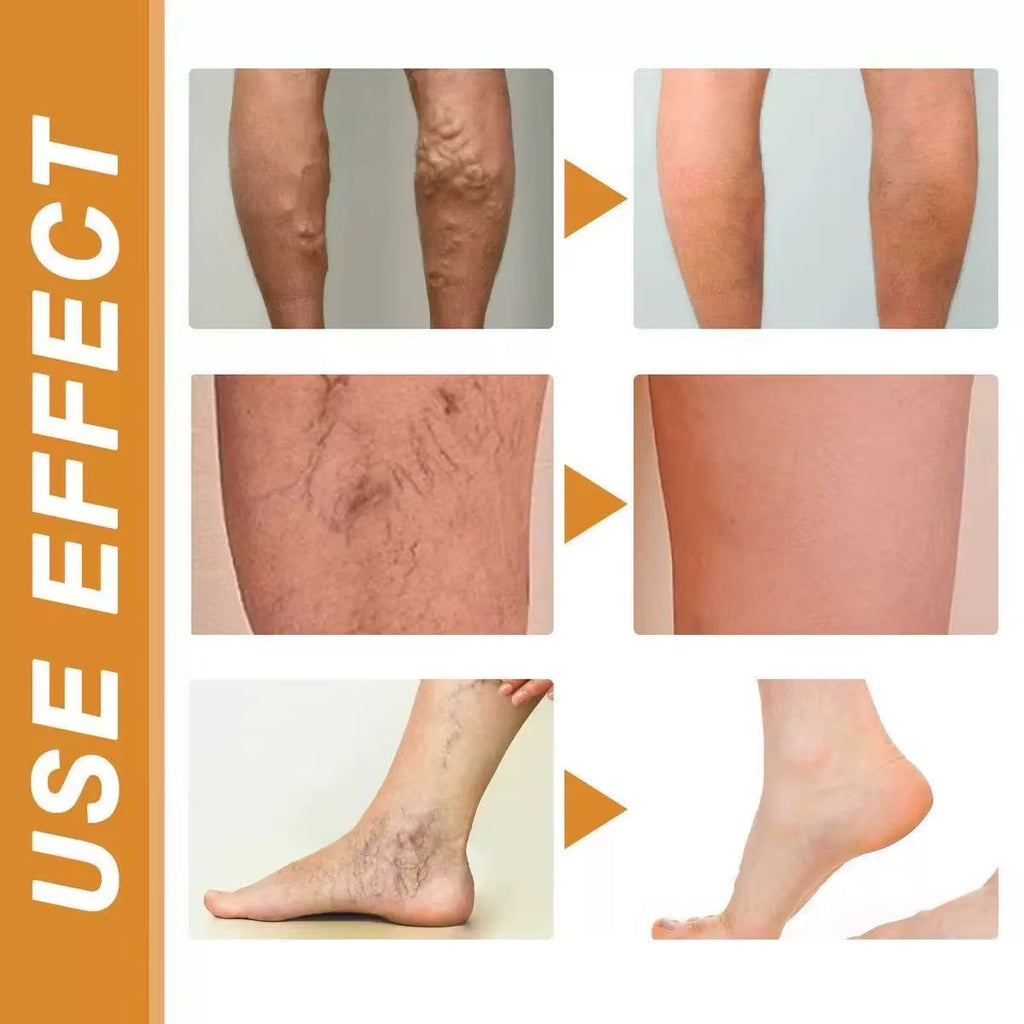 PARCHE PARA VENAS VARICES VARICOSE VEINS