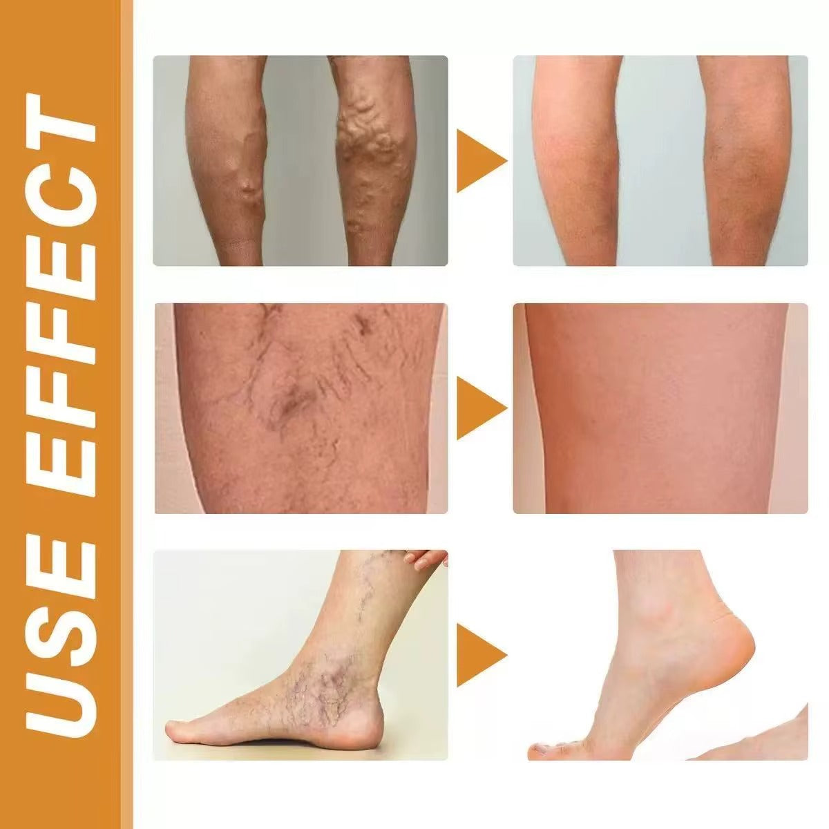 PARCHE PARA VENAS VARICES VARICOSE VEINS